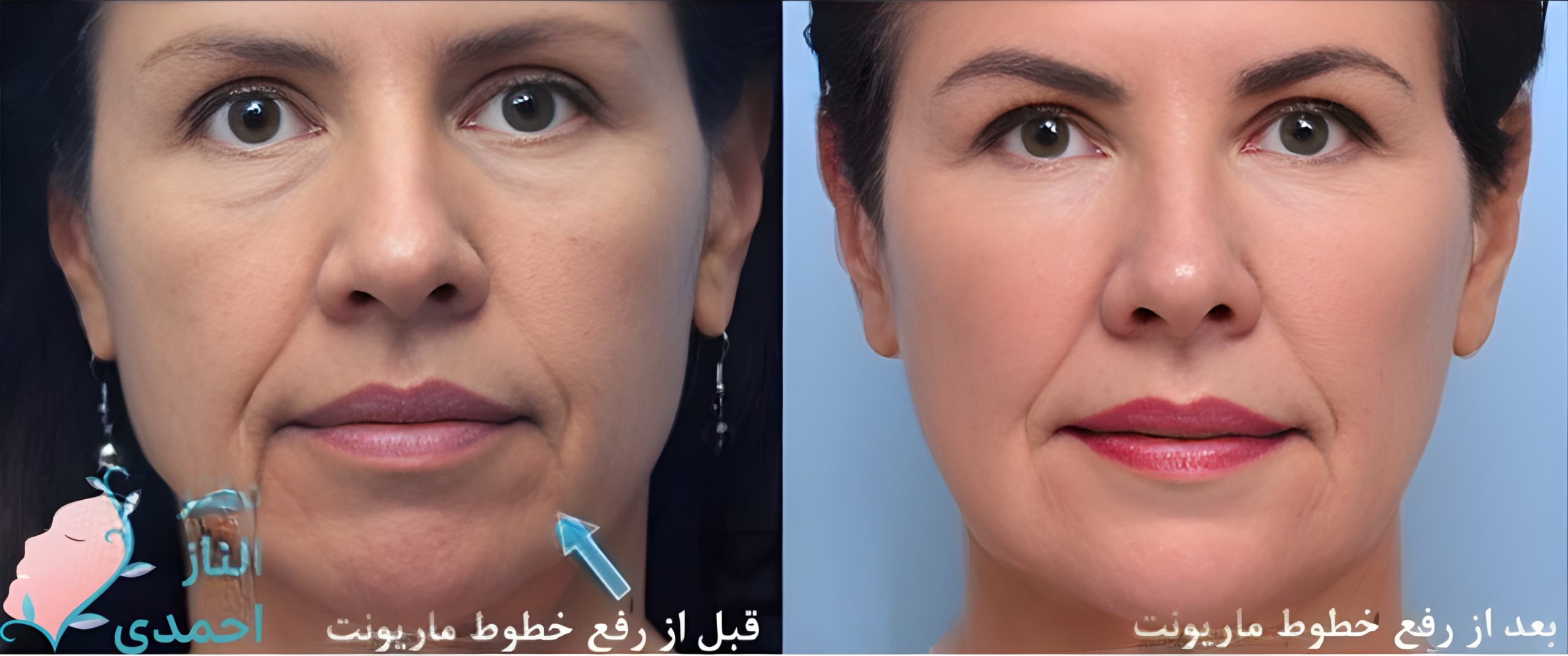 تزریق بوتاکس