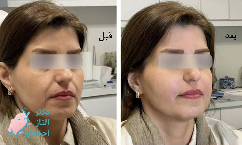 آیا می‌توان خط غم را برطرف کرد؟ 
