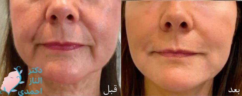 تزریق چربی