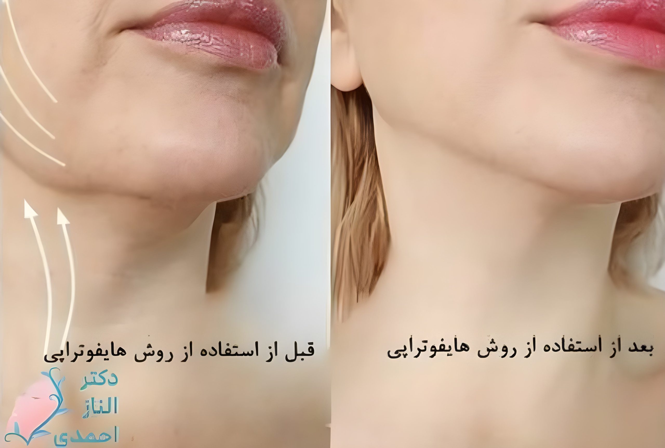 هایفوتراپی