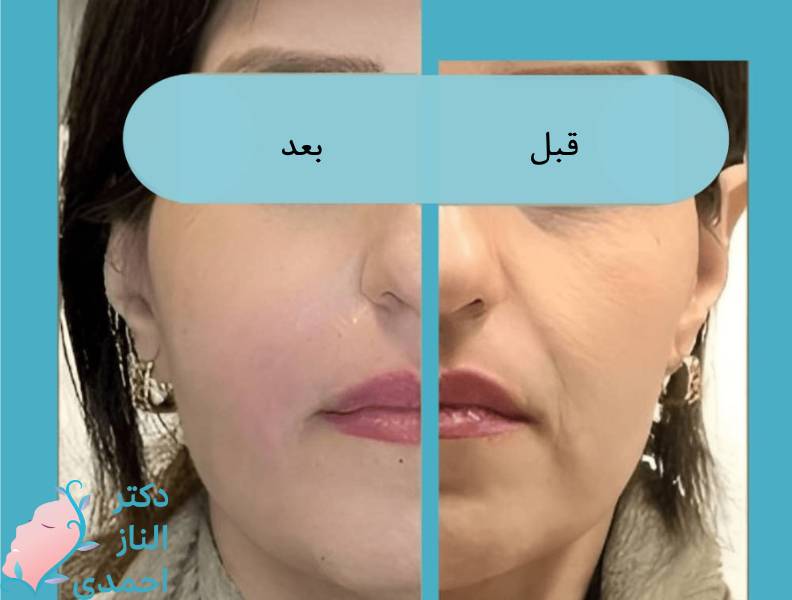 لیفت با نخ
