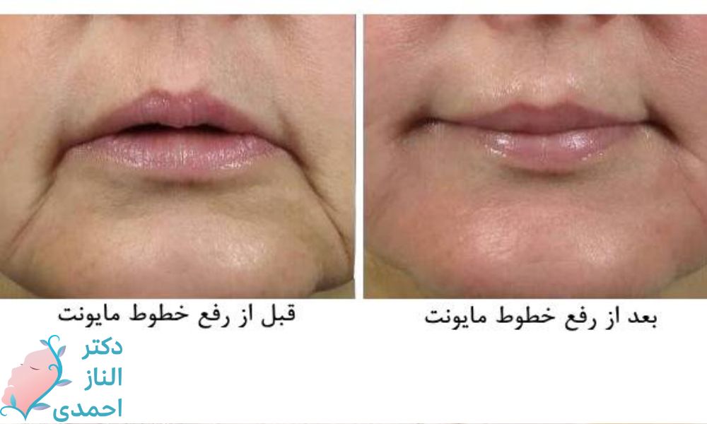 روش­‌‌‌‌های برطرف‌کردن خطوط ماریونت