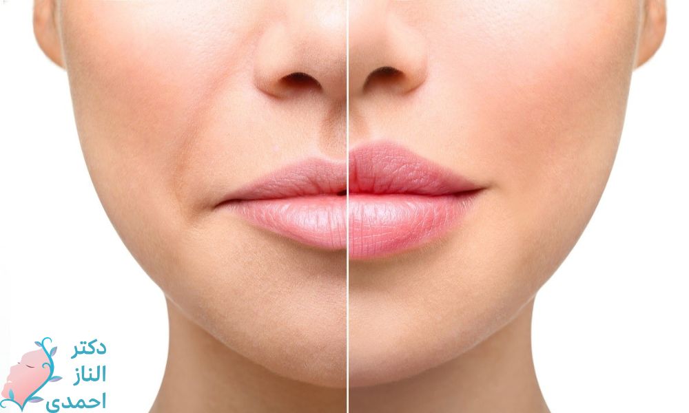 بیش‌ترین حجم لب در بین تمامی مدل‌های ژل لب