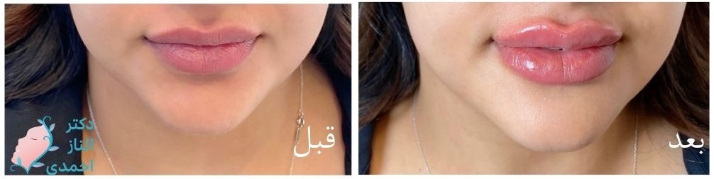 روند تزریق ژل لب عروسکی