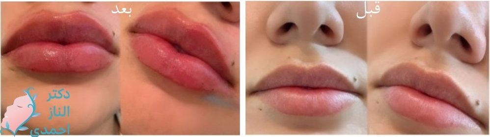 نمونه های قیبل و بعد ژل لب عروسکی