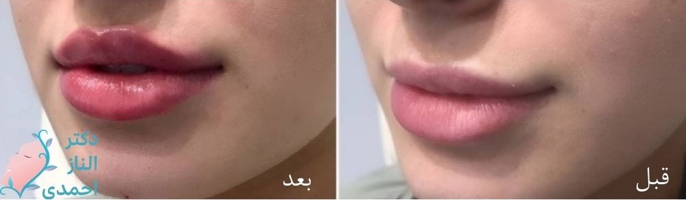 نمونه های قبل و بعد ژل لب عروسکی 