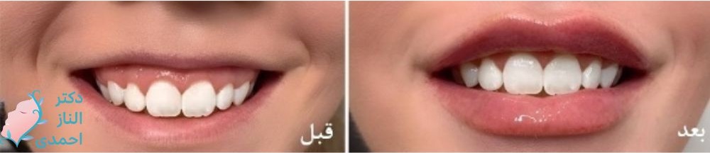 رفع مشکل دیده‌شدن لثه هنگام لبخند