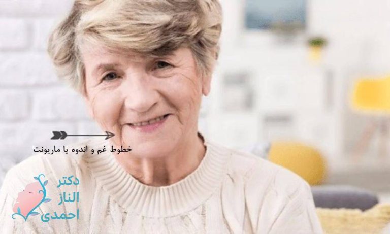 روش‌های برطرف کردن خط غم، اندوه و بغض (ماریونت)