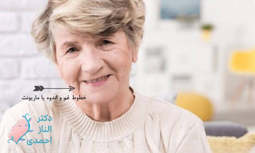 روش‌های برطرف کردن خط غم، اندوه و بغض (ماریونت)