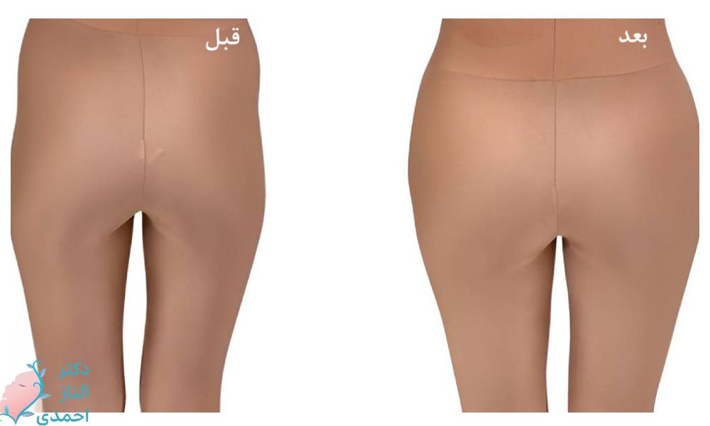 باسن و گودی کنار باسن 