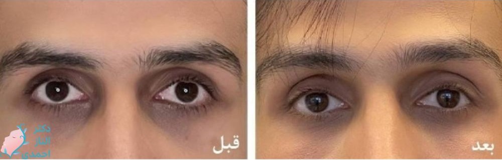 زیر چشم