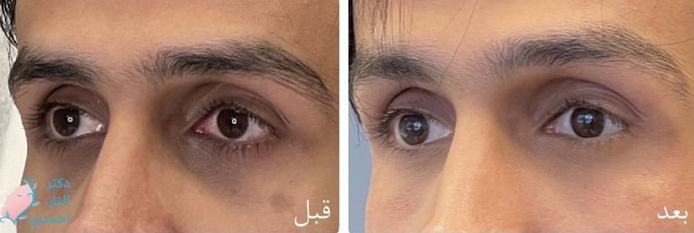 زیر چشم