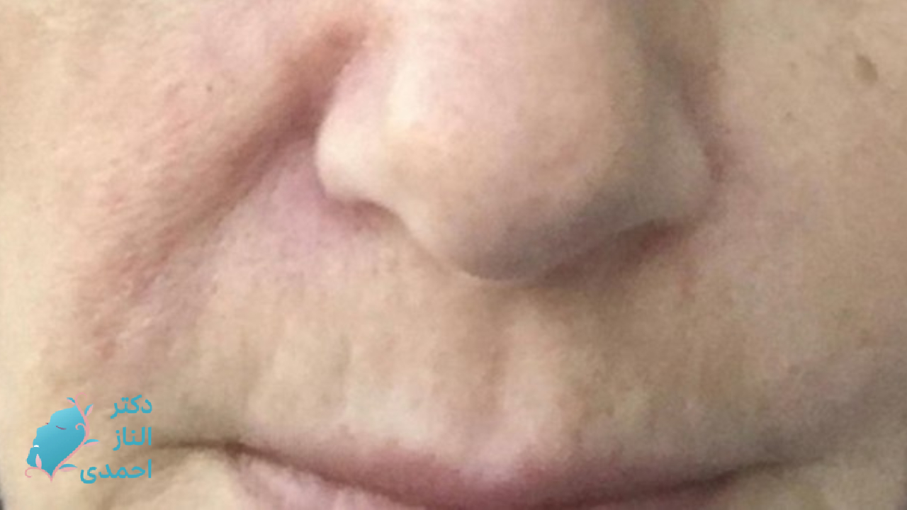 جلوگری از اثر تیندال 