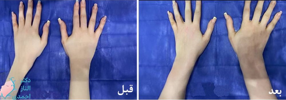 ساق دست