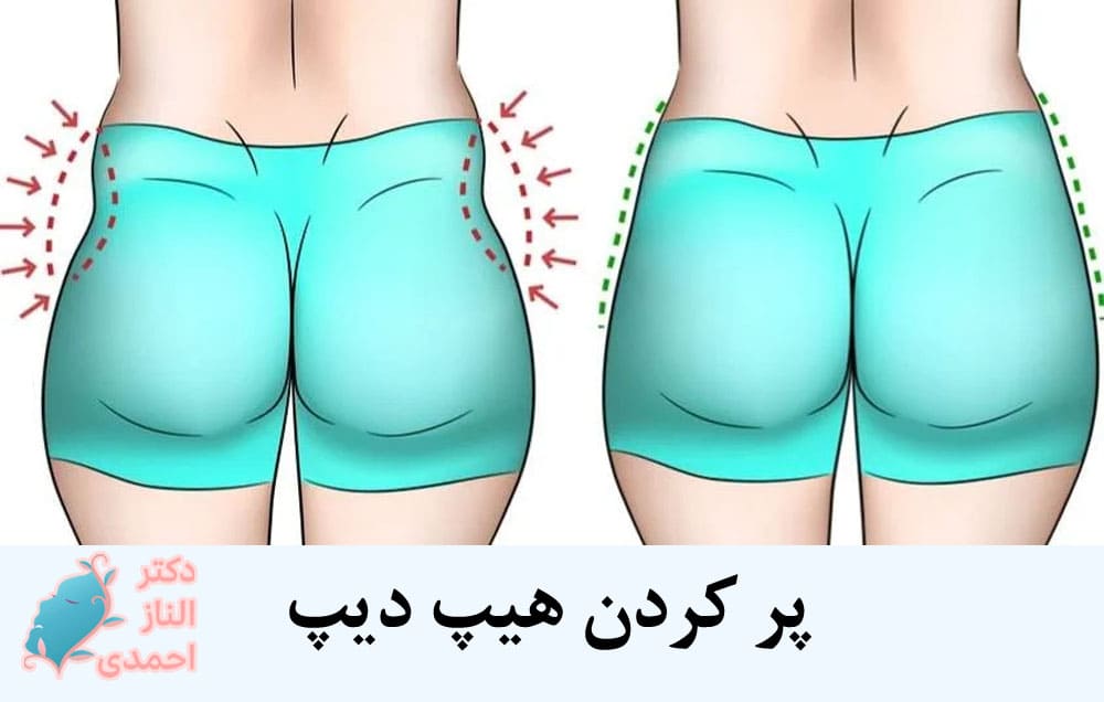 پر کردن هیپ دیپ