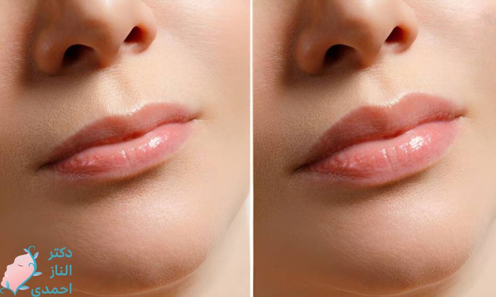 چگونه می‌توانم لب‌هایی با ظاهر طبیعی داشته باشم؟