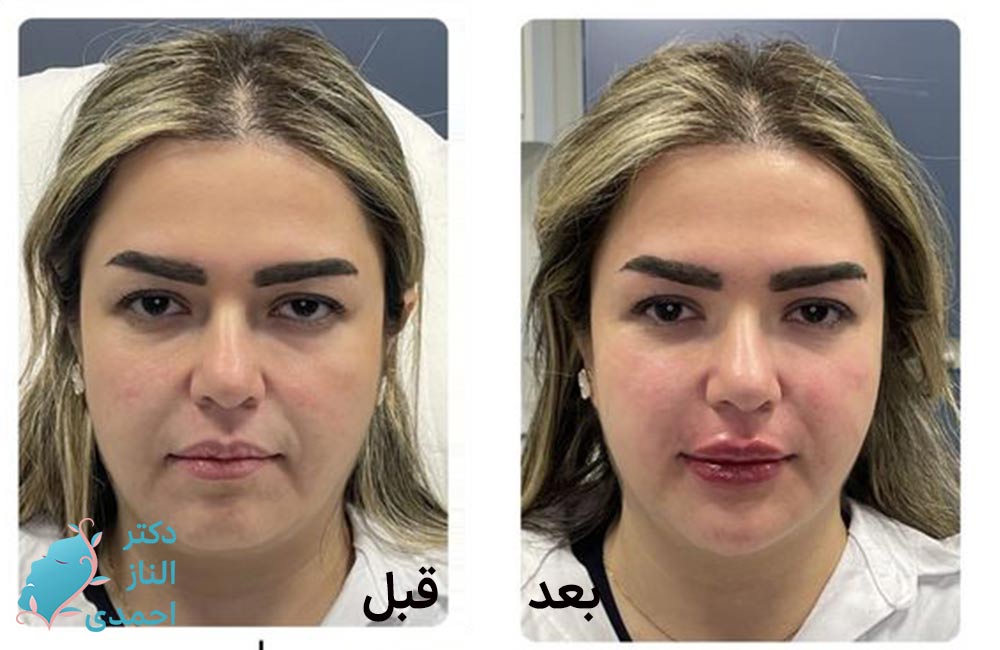کانتورینگ صورت پر و گرد