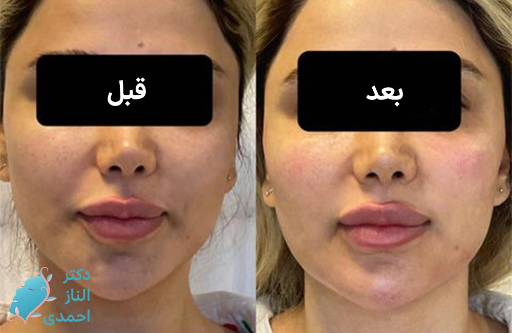 کانتورینگ صورت قلبی