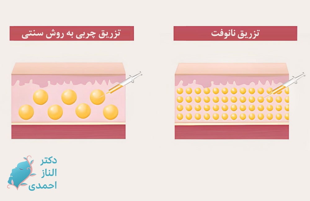 تفاوت نانوفت با تزریق چربی 