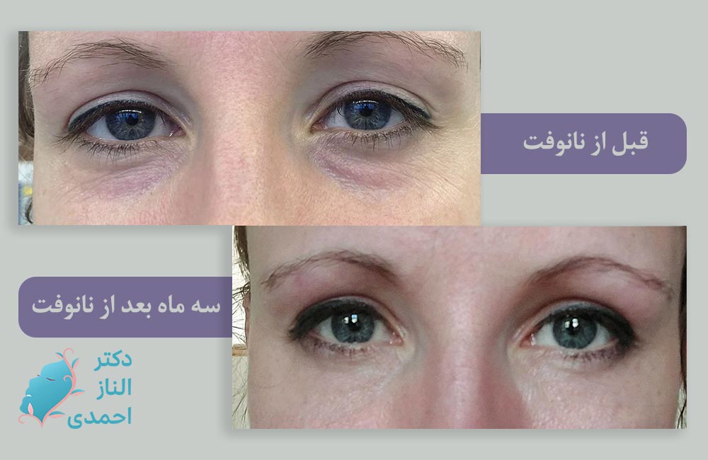گودی و تیرگی زیر چشم