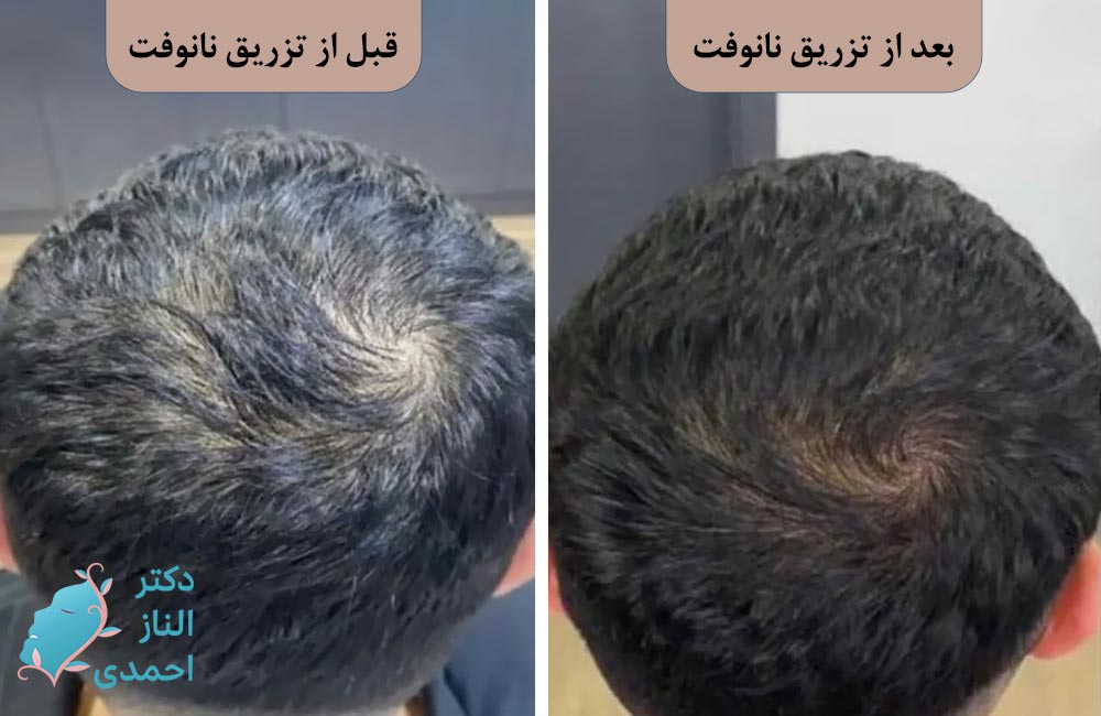 رشد مجدد مو 
