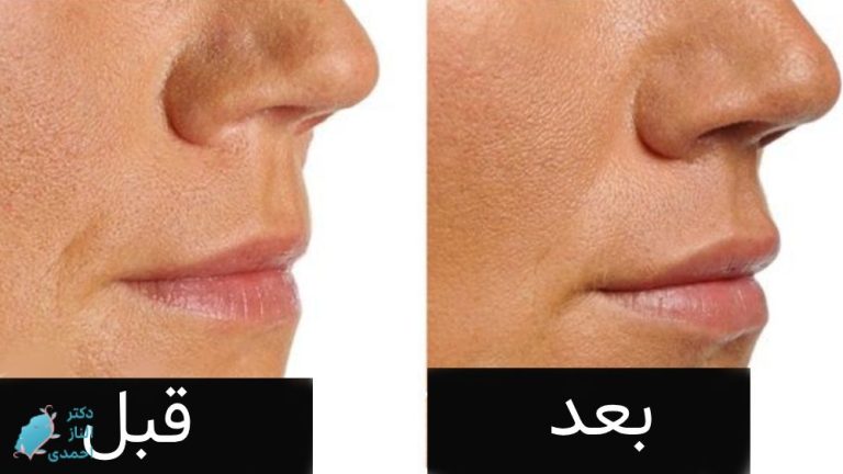 تزریق ژل لب طبیعی(فیلر لب نچرال)،حجم و قیمت