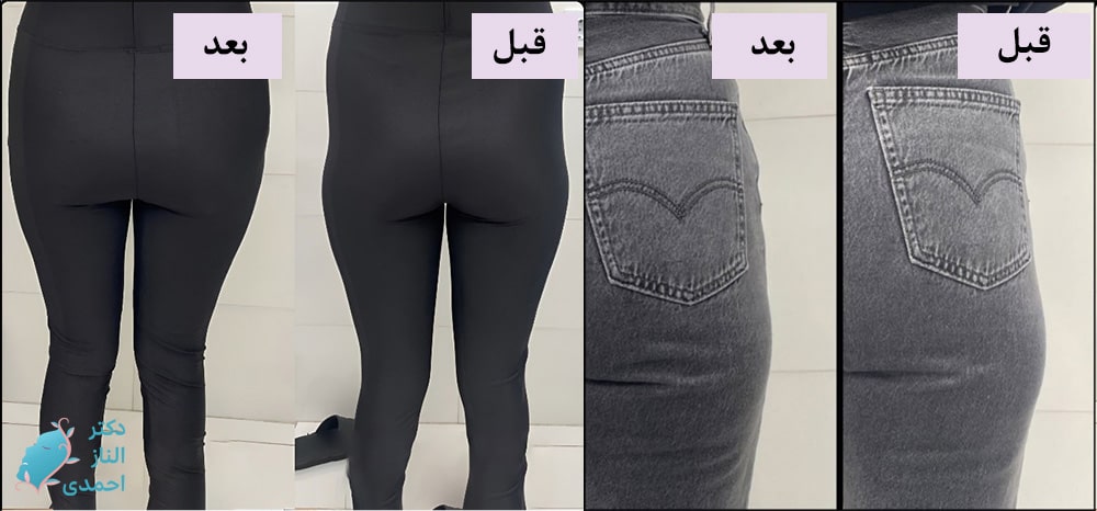 تزریق برای باسن