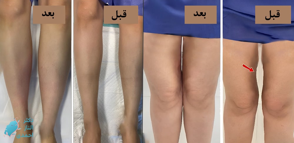 تزریق در ساق پا