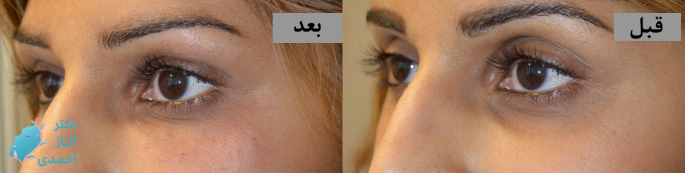 تزریق دور چشم