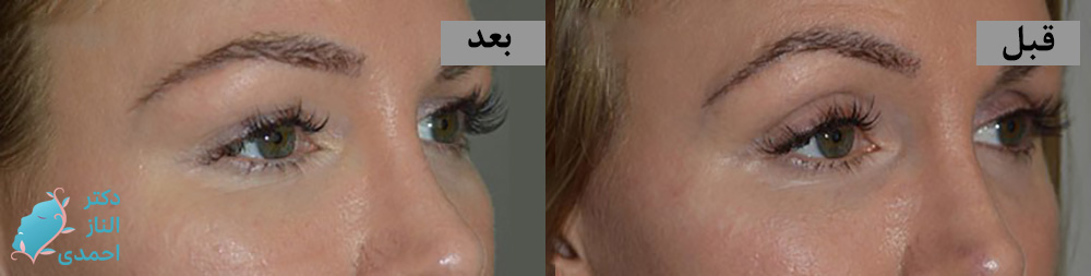 تزریق دور چشم