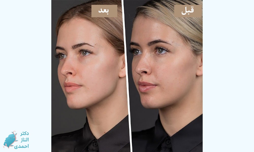 تزریق برای فک