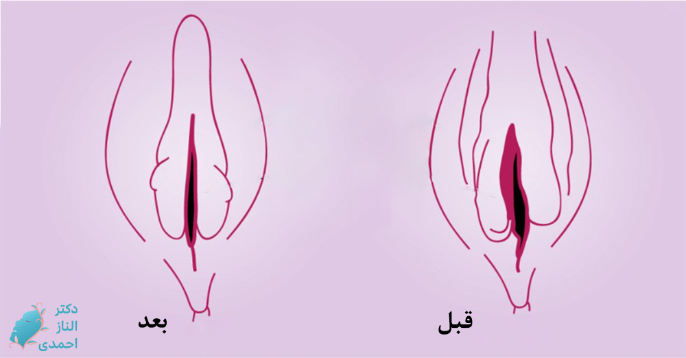 تزریق فیلر به بیکینی