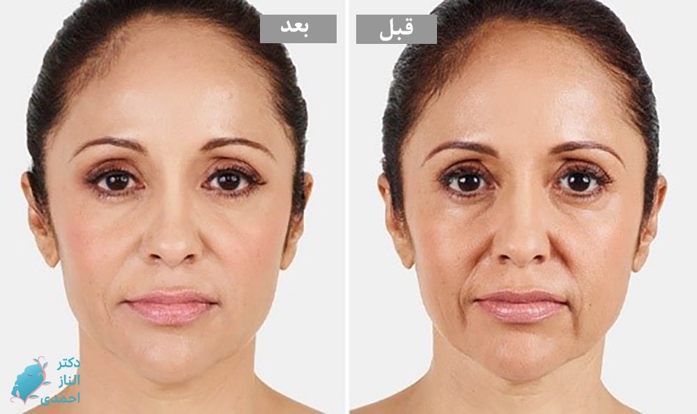 تزریق خط لبخند