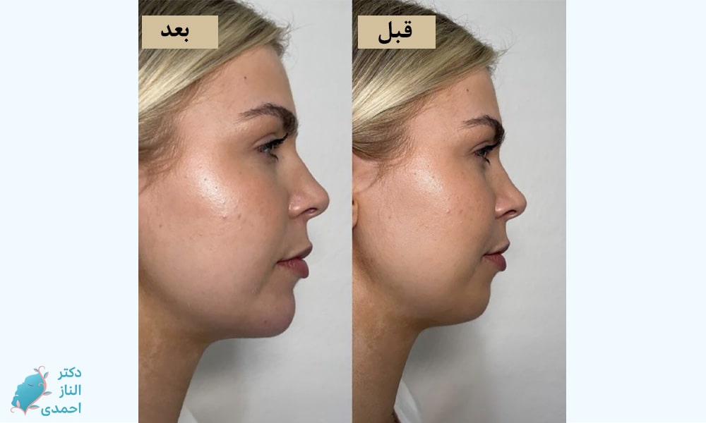 تزریق به چانه