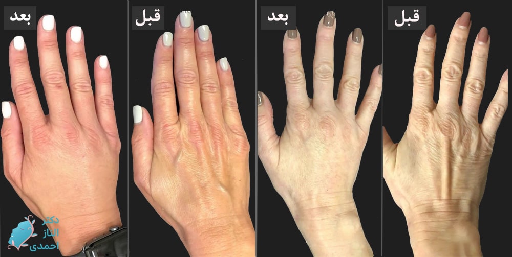 تزریق فیلر به دست