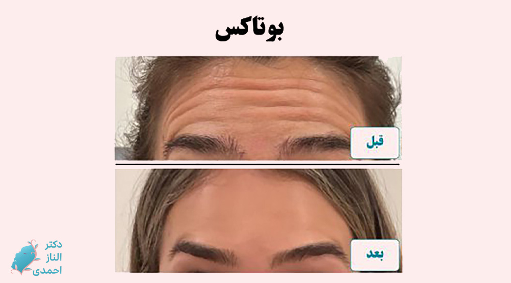 بوتاکس پیشانی