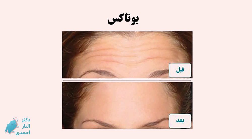 بوتاکس پیشانی