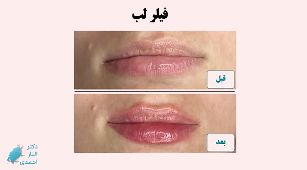 فیلر لب