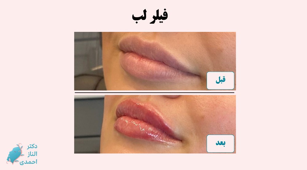 فیلر لب