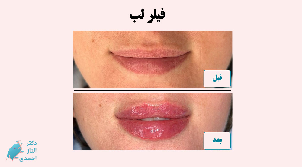 فیلر لب