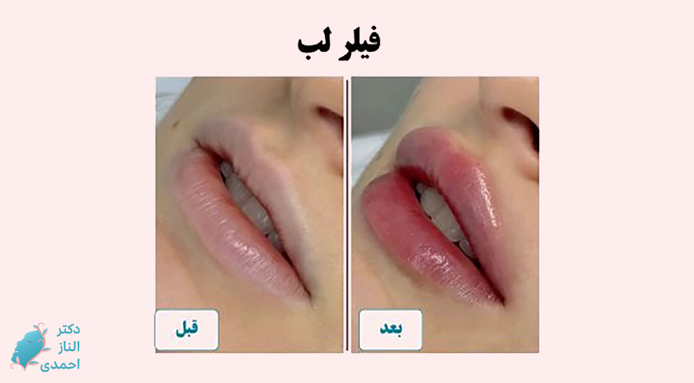 فیلر لب
