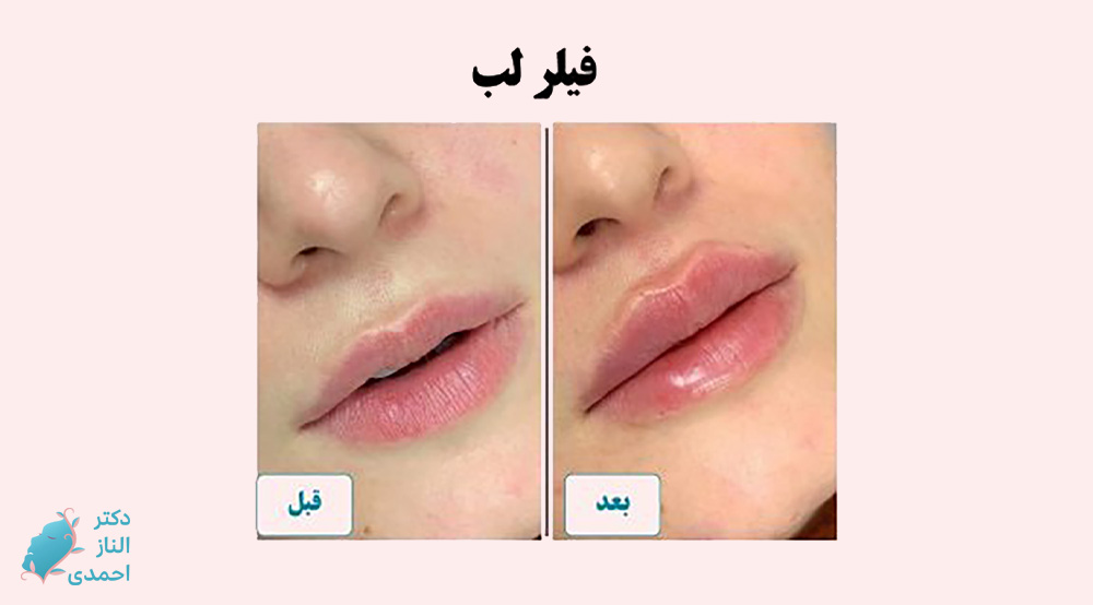 فیلر لب