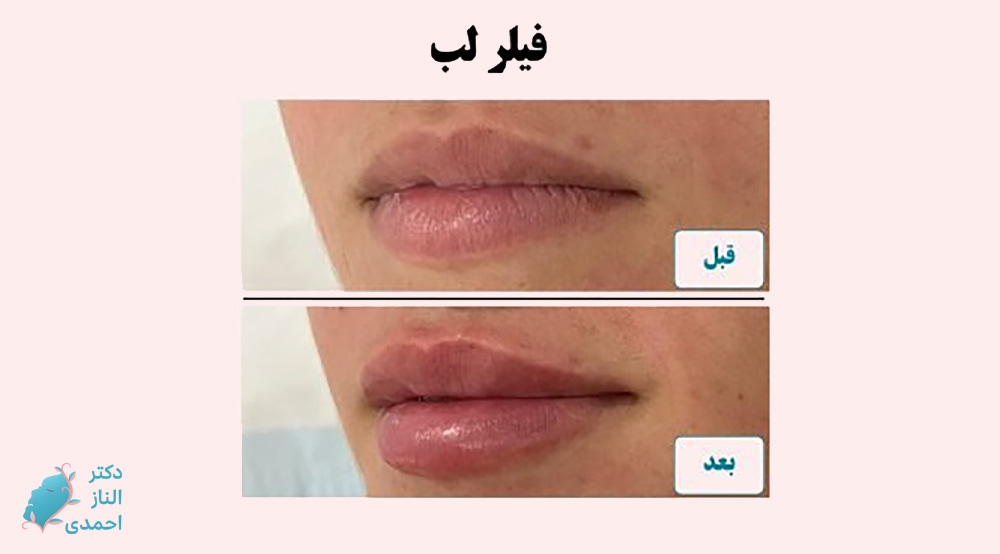 فیلر لب