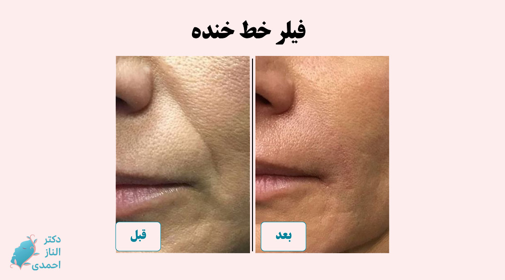 فیلر خط خنده