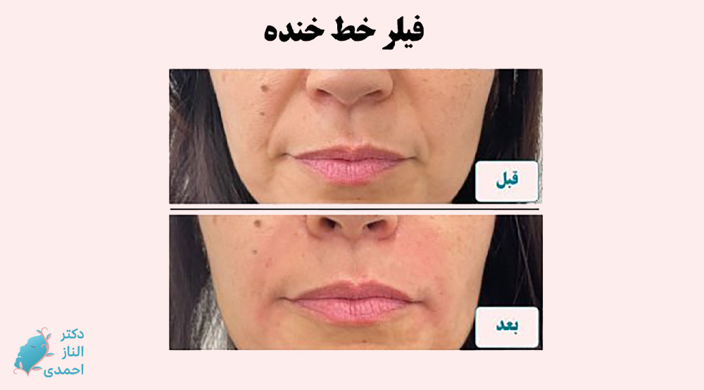 فیلر خط خنده
