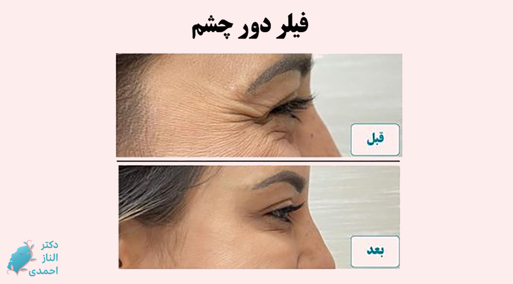 فیلر چشم