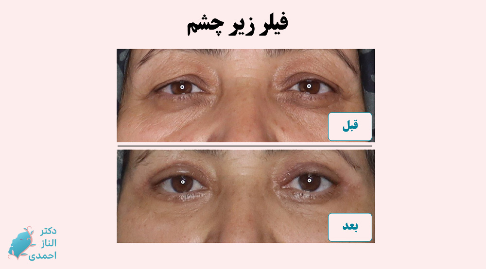 فیلر چشم