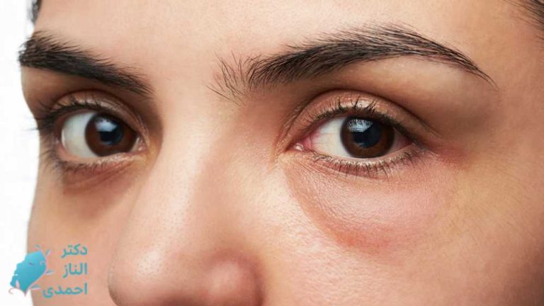 عوارض تزریق فیلر زیر چشم، دلایل و راه‌های پیشگیری