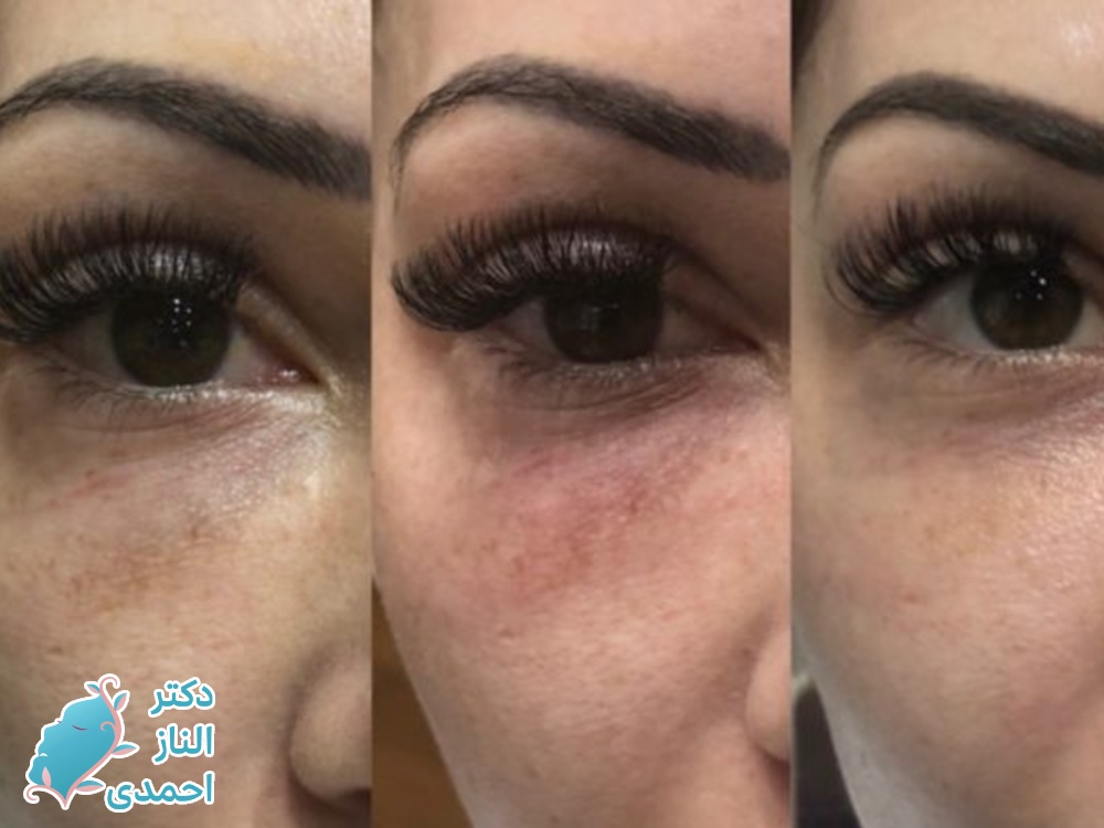 اثر تیندال از عوارض فیلر چشم