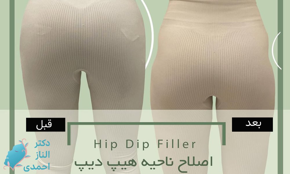 برطرف کردن گودی کنار لگن و باسن (هیپ دیپ)
